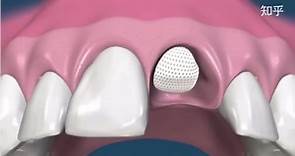 医学3D视频：“种植牙”全过程-门牙种植