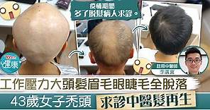 【女士脫髮問題】工作壓力大頭髮眉毛眼睫毛全脫落　43歲女子求診中醫髮再生【附治療方法】 - 香港經濟日報 - TOPick - 健康 - 醫生診症室