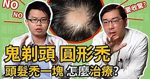 為什麼會有圓形禿？鬼剃頭是因為壓力大嗎？楊省三醫師與林政賢醫師來告訴你圓禿應該怎麼治療！