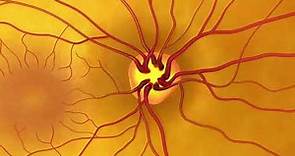 (AD) El examen completo de los ojos con dilatación de las pupilas