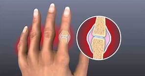 Rheumatoid Arthritis - Mayo Clinic