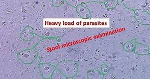 Heavy load of parasites in stool|| Stool microscopic examination|| Trichomonas hominis