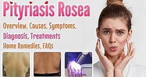 Pityriasis Rosea Overview, Causes, Signs and Symptoms, Diagnosis, Treatment, Home Remedies, and FAQs