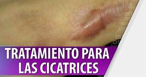 Tratamientos para las Cicatrices