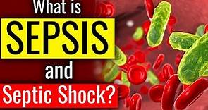 What is SEPSIS and SEPTIC SHOCK ? The Body's Deadly response to Infection. Sepsis - Cause. Symptom.