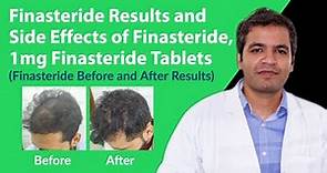 Finasteride Results and Finasteride Side Effects | Finasteride 1mg Tablets Before and After Results
