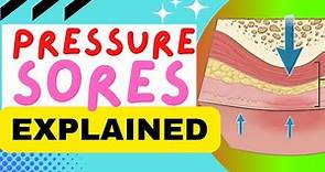 PRESSURE SORES EXPLAINED - CAUSES, STAGES, MANAGEMENT, TREATMENT - PRESSURE ULCERS AND BED SORES