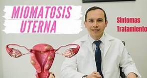 Miomatosis uterina (TODO LO QUE DEBES SABER)