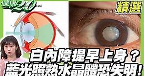 白內障提早上身？藍光照熟水晶體恐失明！眼科專家的護眼處方學起來！健康2.0 (完整版)