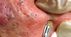 How To Remove Blackheads And Whiteheads On Face Easy #121 ✦ Dr Laelia ✦
