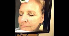 Profractional Laser Treatment with PRP | Laser Center of Maryland