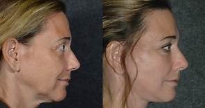 Facelift Surgery S-Lift on 50-Year-Old Woman | Ponytail Technique Facelift #ponytailfacelift