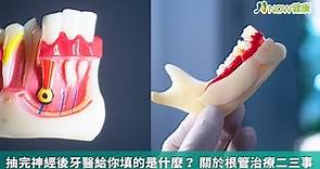 抽完神經後牙醫給你填的是什麼？ 關於根管治療二三事