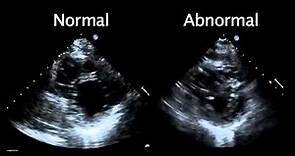 Echocardiogram from the Patient Compared with That from a Normal Control | NEJM
