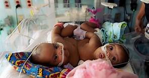 Conjoined twin sisters successfully separated in historic surgery at Texas hospital