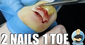 UNBELIEVABLE FUSED TOENAIL REMOVAL