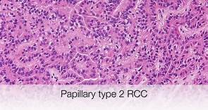 Papillary Renal Cell Carcinoma - Pathology mini tutorial