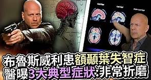 布魯斯威利患「額顳葉失智症」 醫曝3大典型症狀：非常折磨 @ChinaTimes