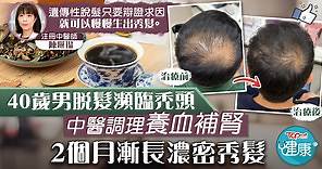 【脫髮困擾】40歲男脫髮瀕臨禿頭　中醫調理2個月漸長濃密秀髮 - 香港經濟日報 - TOPick - 健康 - 保健美顏