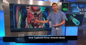 How Typhoid Fever Affects the Body -- The Doctors