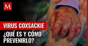 ¿Qué es el virus Coxsackie y cómo prevenirlo?