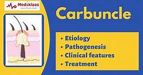 Carbuncle: The cluster of boils | General Surgery | Mediklaas