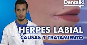 Tratamiento del HERPES LABIAL, causas y síntomas de la CALENTURA en el labio | Dentalk! ©