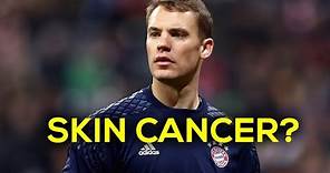 Manuel Neuer had Battled SKIN CANCER 😔😢