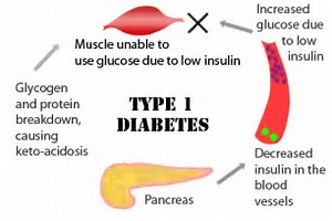 Image result for diabetes type 1
