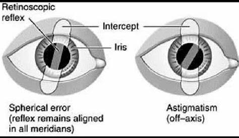 Retinoscopy of the eye (Ophthalmology) - YouTube | Optometry, Opthalmic