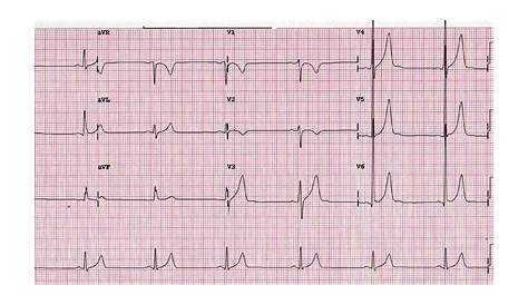 heart test chart abbr