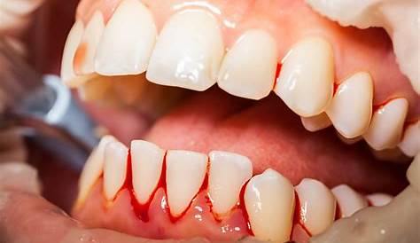 Why do my gums bleed?