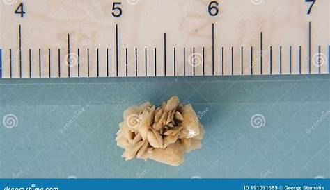 5 Mm Kidney Stone Laying On Naked Belly Stock Photo | CartoonDealer.com