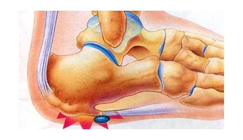 areas of heel pain diagram