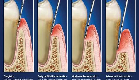 What are the stages of gum disease? – Britten Perio