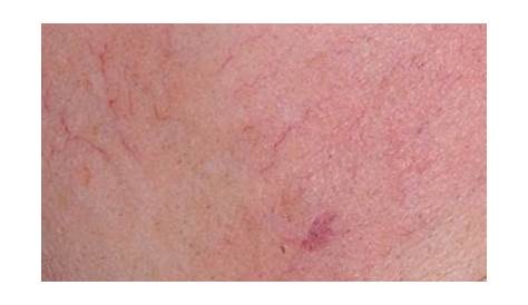 types of vascular skin lesions