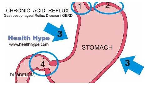 Chronic Reflux | Persistent, Constant, Recurrent Acid Reflux