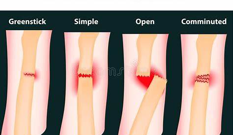 Typical bone fractures. Vector scheme , #SPONSORED, #bone, #Typical, #