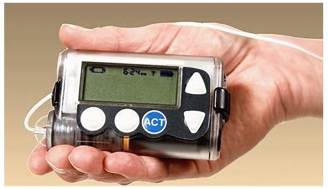 Pompa insulinowa - jak działa, wady, zalety, ile kosztuje? - 1001PORAD