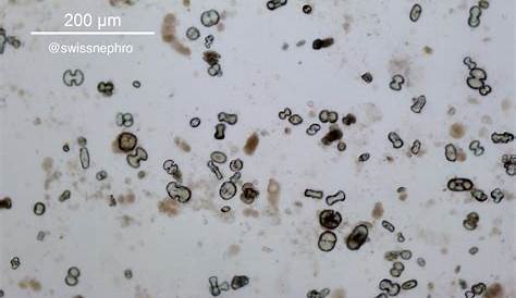 Urine Sediment of the Month: Common Crystals! - Renal Fellow Network