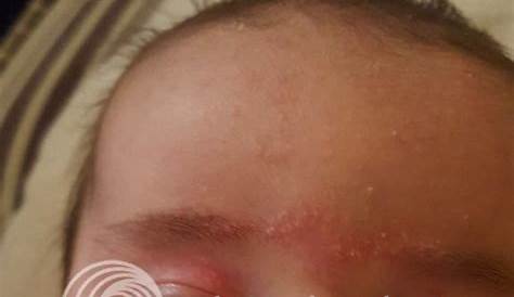 red birthmark on baby