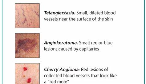 what are vascular lesions