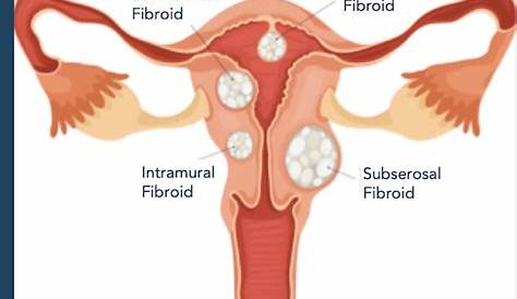 Fibroid Types, Sizes, Location, & FIGO Classifications Explained
