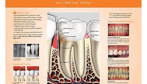gum disease stages chart