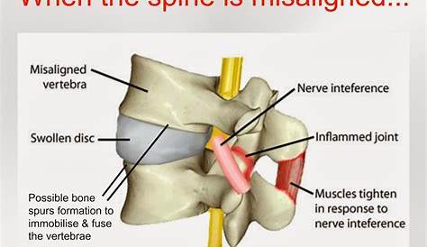 Wellness for Life Chiropractic | SPINAL MISALIGNMENT