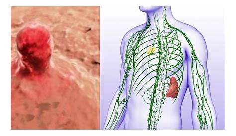 The Lymph System Allows Cancer To Spread. These Are The 9 Ways To Stop