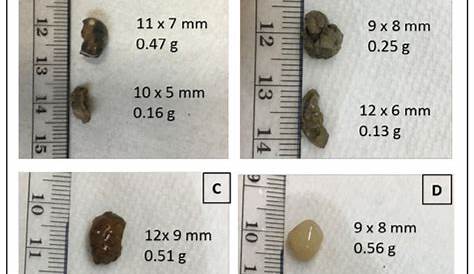 Image of each stone used in the study: (A) calcium oxalate monohydrate