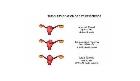 intramural fibroid size chart
