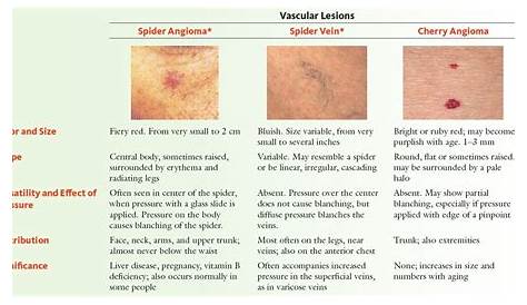 Vascular Lesions: Spider Angioma, Spider Vein, Cherry | GrepMed