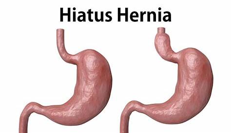 what size hiatal hernia is big